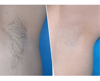 Young girl Before and After Skin Treatment